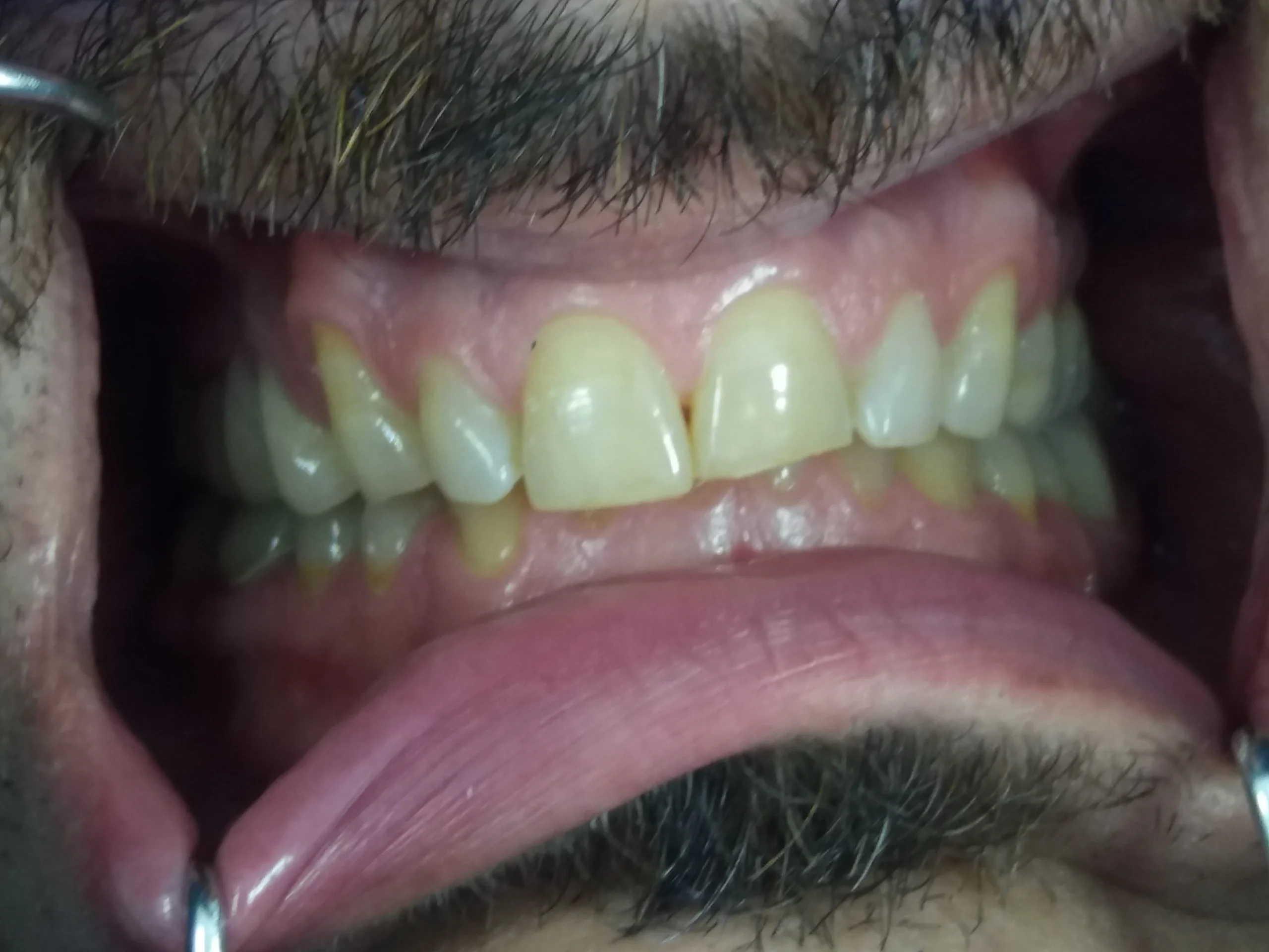 Facetas 4 Facetas 4