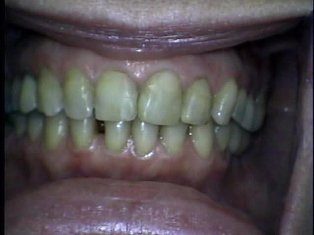 Facetas Porcelana 1 Facetas Porcelana 1