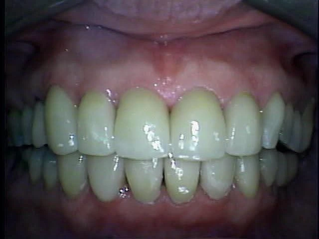Facetas Porcelana 2 Facetas Porcelana 2